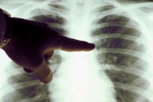 Anchetă epidemiologică la Slobozia din cauza a două femei bolnave de TBC