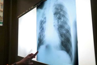 Ialomița pierde lupta împotriva Tuberculozei