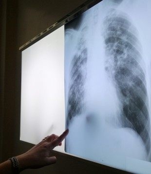 Peste 140 de ialomițeni, diagnosticați cu Tuberculoză