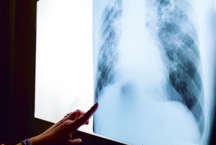 Ialomița: Incidența cazurilor de TBC a scăpat de sub controlul medicilor