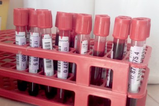 8000 de ialomițeni testați pentru hepatitele virale B și C