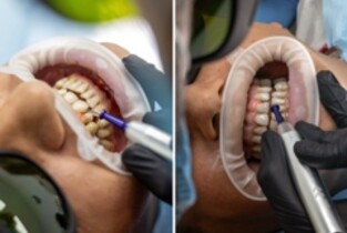 Recuperarea după chiuretaj parodontal-sfaturi de la specialiști în sănătate dentară