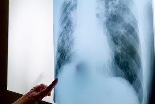 Ialomița, pe «harta roșie» a cazurilor de Tuberculoză