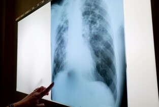 Depistarea precoce a cancerului pulmonar, în zonele vulnerabile din Ialomița